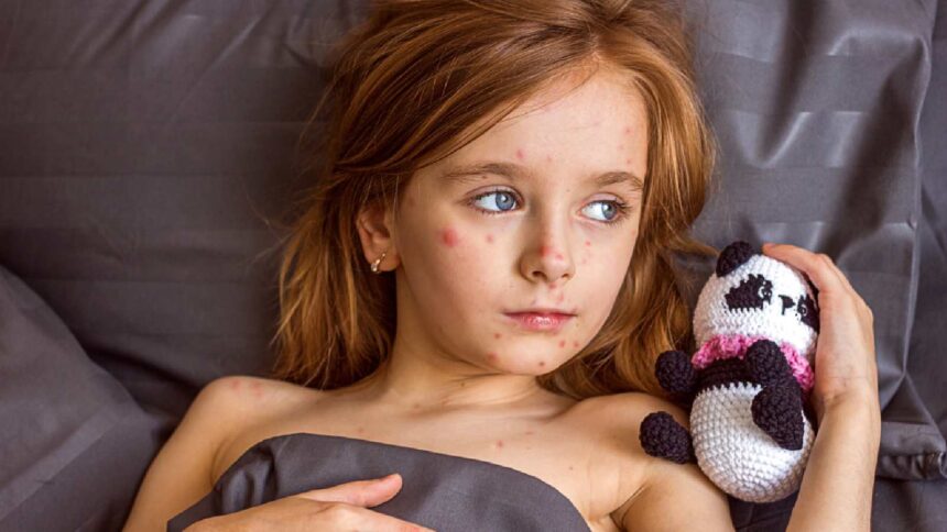 Measles outbreak in the US: Dos and don’ts for people affected by this contagious disease